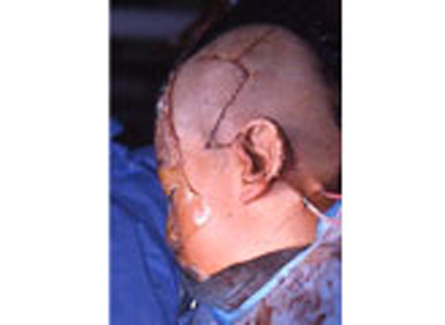 info_on_the_earPlacement-of-Skin-Graft