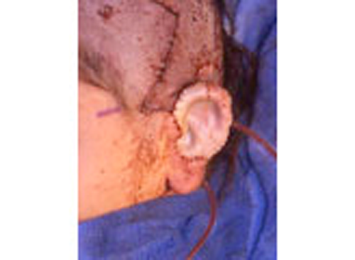 info_on_the_earSkin-Graft-With-drains