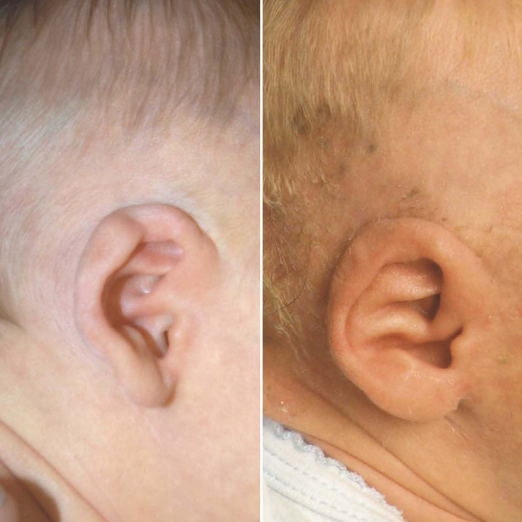 Pre & Post Ear Molding Surgery