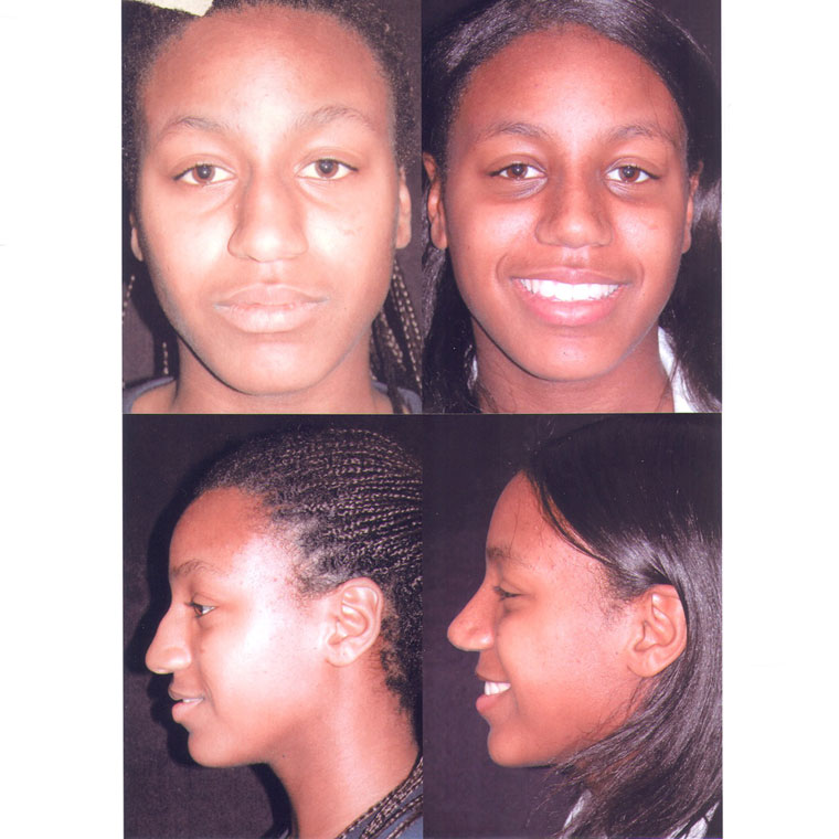 Before & After Rhinoplasty