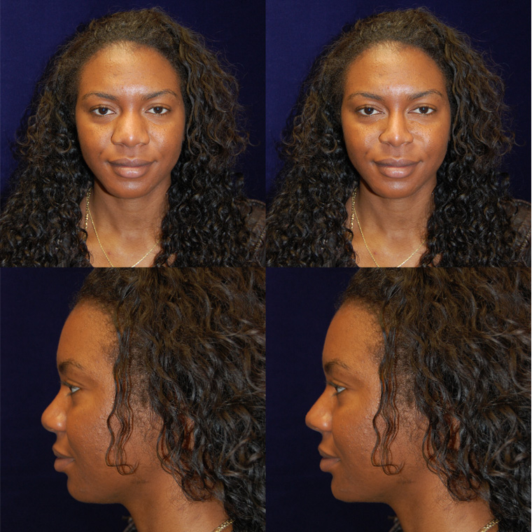 Before & After Rhinoplasty