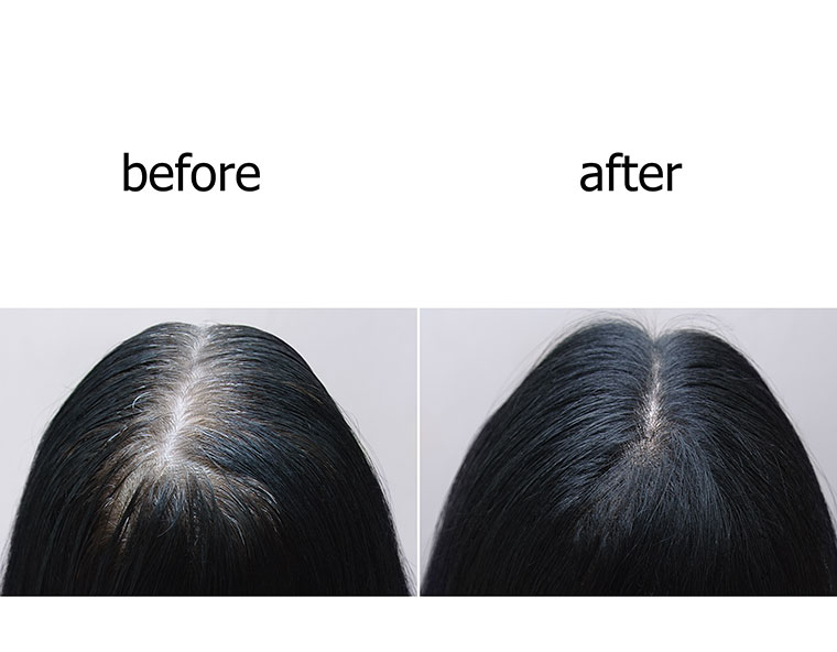 Pre & Post Hair Transplant
