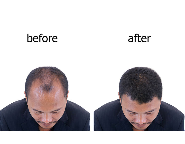 Pre & Post Hair Transplant - Dr. Robert Ruder