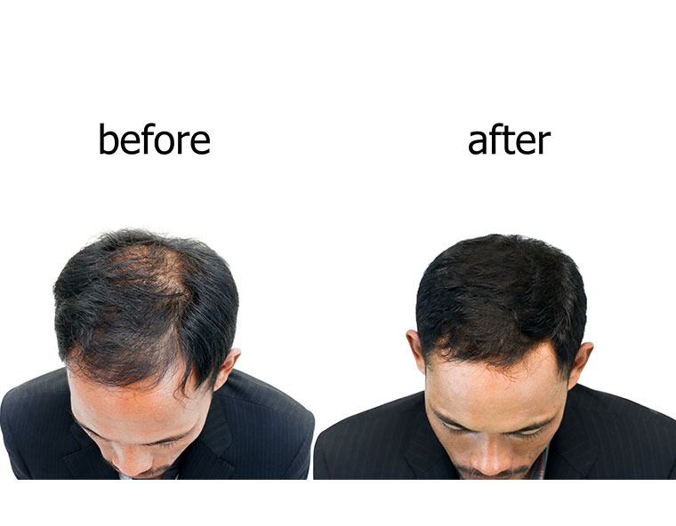 Pre & Post Hair Transplant